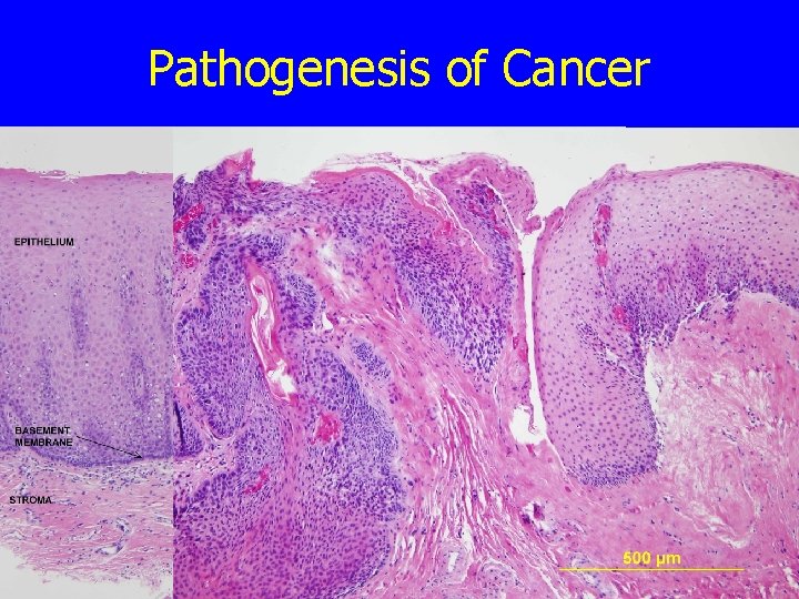 Pathogenesis of Cancer 