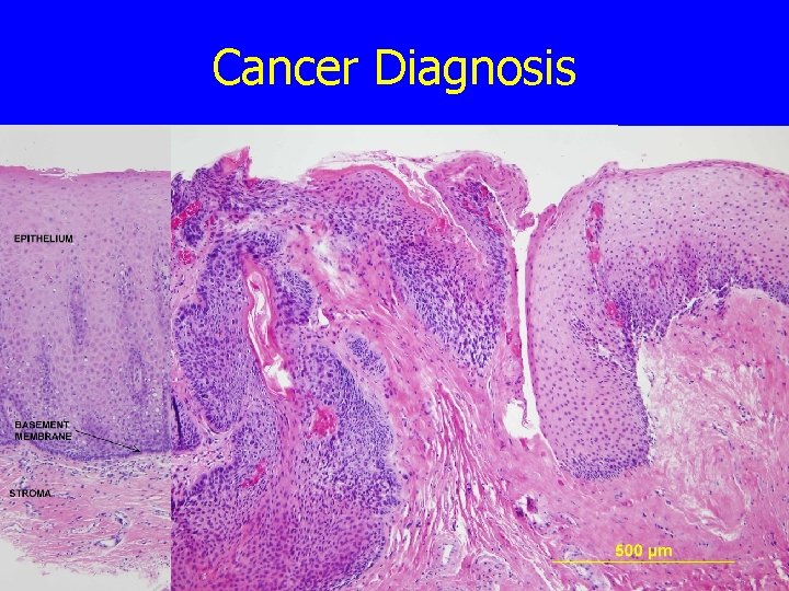 Cancer Diagnosis 