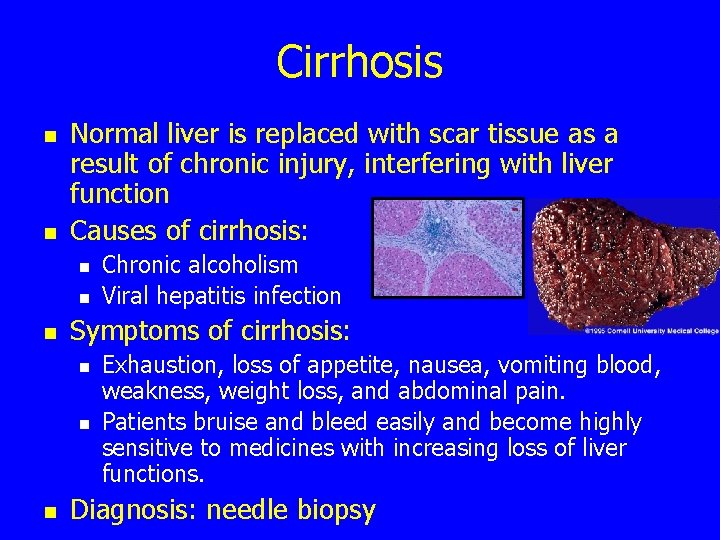 Cirrhosis n n Normal liver is replaced with scar tissue as a result of