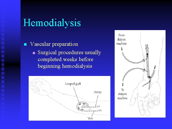 Hemodialysis n Vascular preparation u Surgical procedures usually completed weeks before beginning hemodialysis 