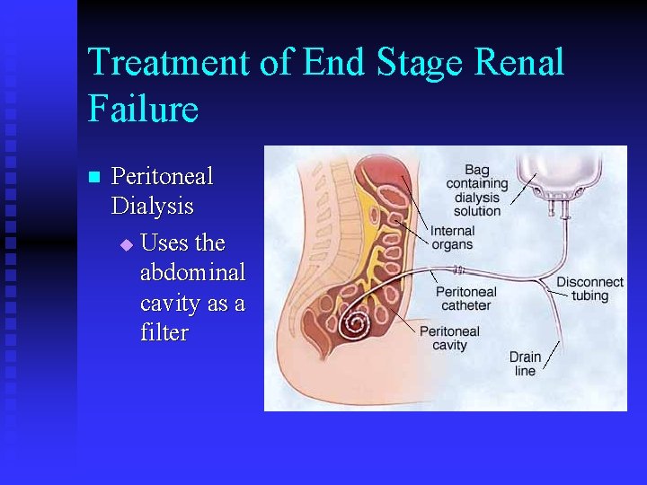 Treatment of End Stage Renal Failure n Peritoneal Dialysis u Uses the abdominal cavity