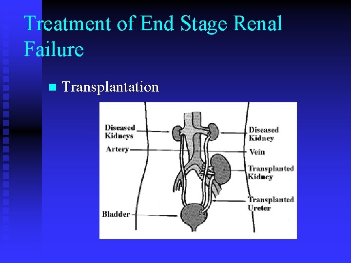 Treatment of End Stage Renal Failure n Transplantation 