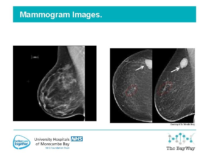 Mammogram Images. 