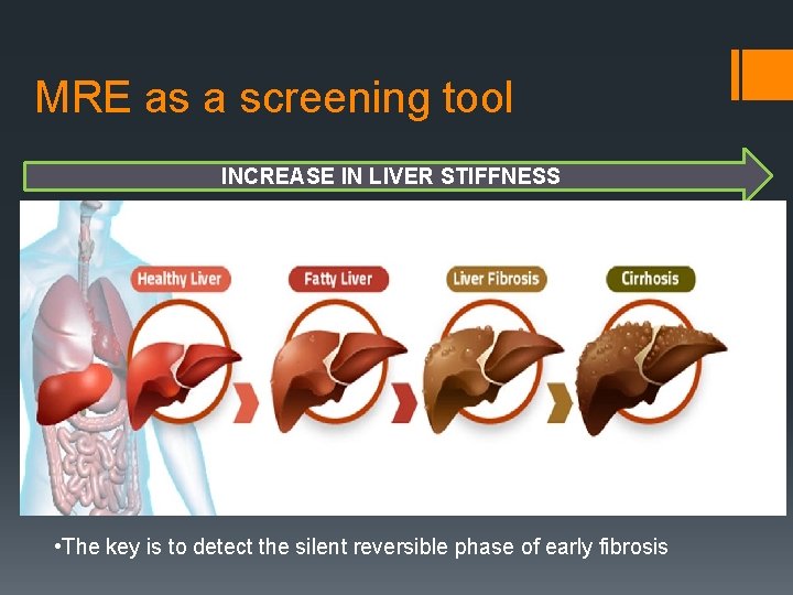 MRE as a screening tool INCREASE IN LIVER STIFFNESS • The key is to