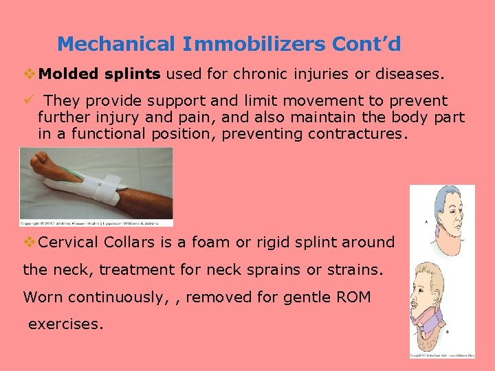Mechanical Immobilizers Cont’d v Molded splints used for chronic injuries or diseases. ü They