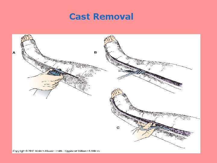 Cast Removal 