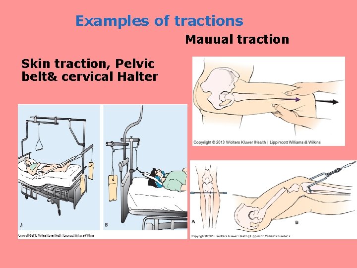 Examples of tractions Mauual traction Skin traction, Pelvic belt& cervical Halter 