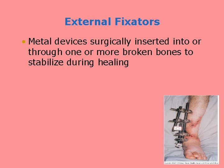 External Fixators • Metal devices surgically inserted into or through one or more broken