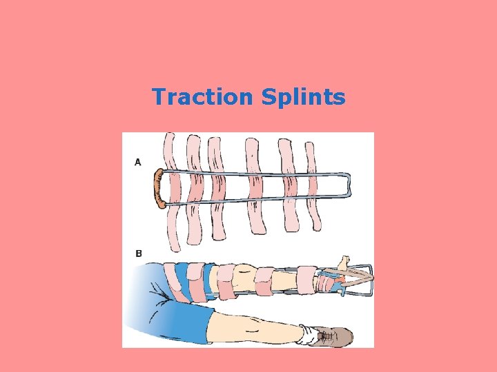 Traction Splints 