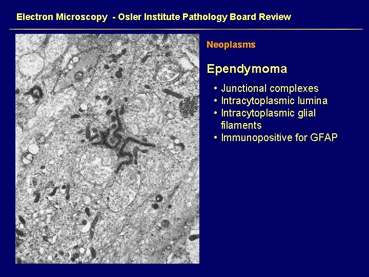 Electron Microscopy - Osler Institute Pathology Board Review Neoplasms Ependymoma • Junctional complexes •