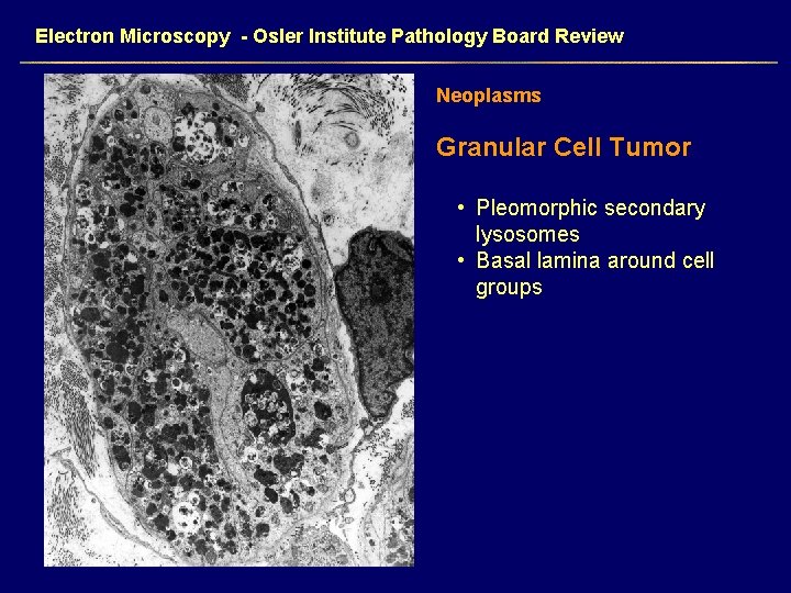 Electron Microscopy - Osler Institute Pathology Board Review Neoplasms Granular Cell Tumor • Pleomorphic