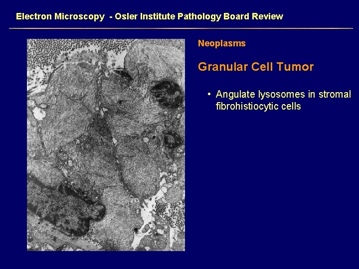 Electron Microscopy - Osler Institute Pathology Board Review Neoplasms Granular Cell Tumor • Angulate