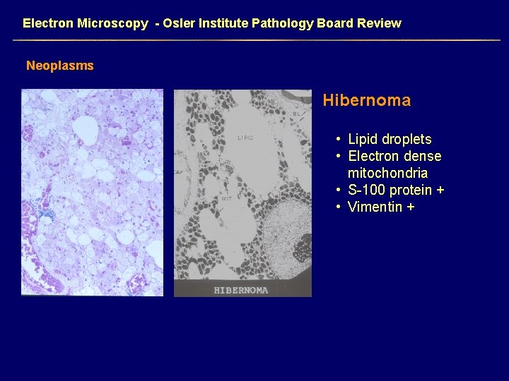 Electron Microscopy - Osler Institute Pathology Board Review Neoplasms Hibernoma • Lipid droplets •
