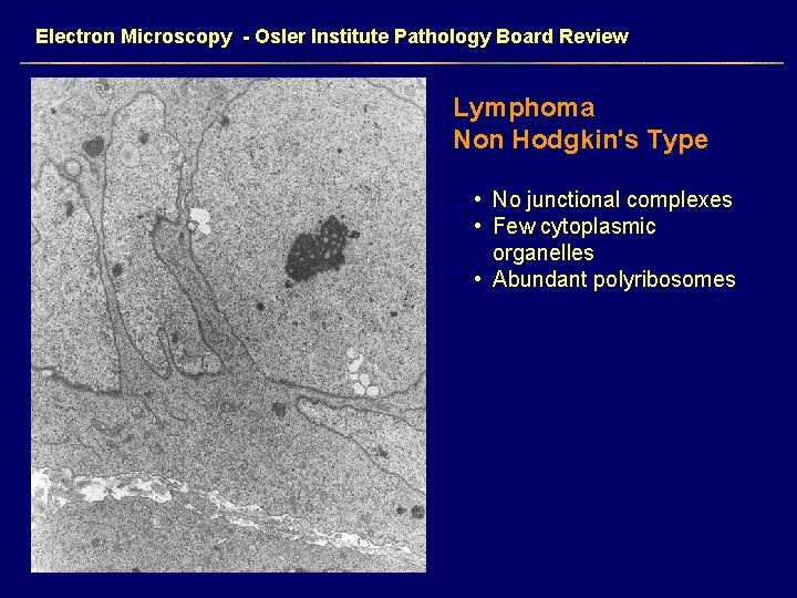 Electron Microscopy - Osler Institute Pathology Board Review Lymphoma Non Hodgkin's Type • No