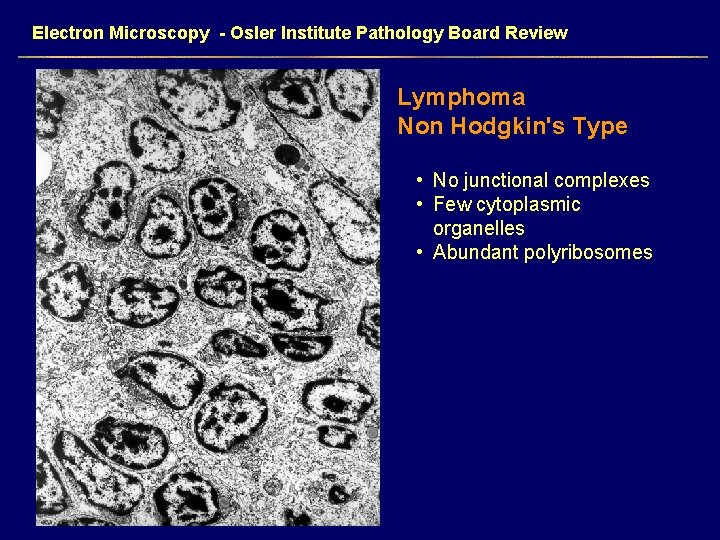 Electron Microscopy - Osler Institute Pathology Board Review Lymphoma Non Hodgkin's Type • No