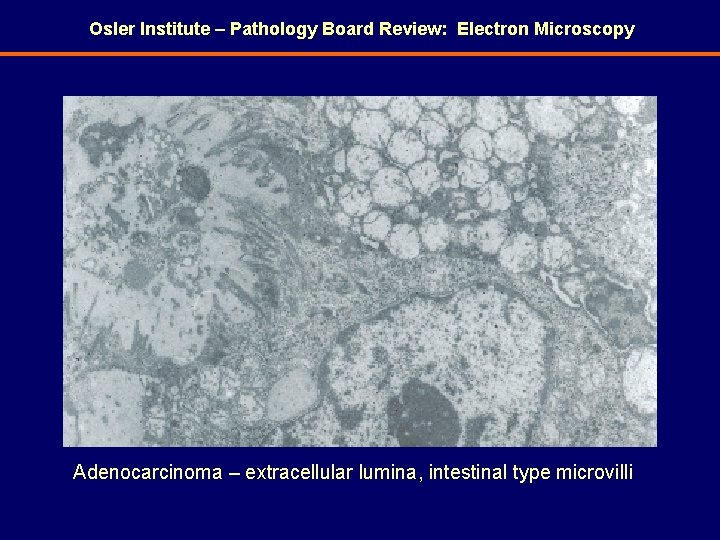 Osler Institute – Pathology Board Review: Electron Microscopy Adenocarcinoma – extracellular lumina, intestinal type