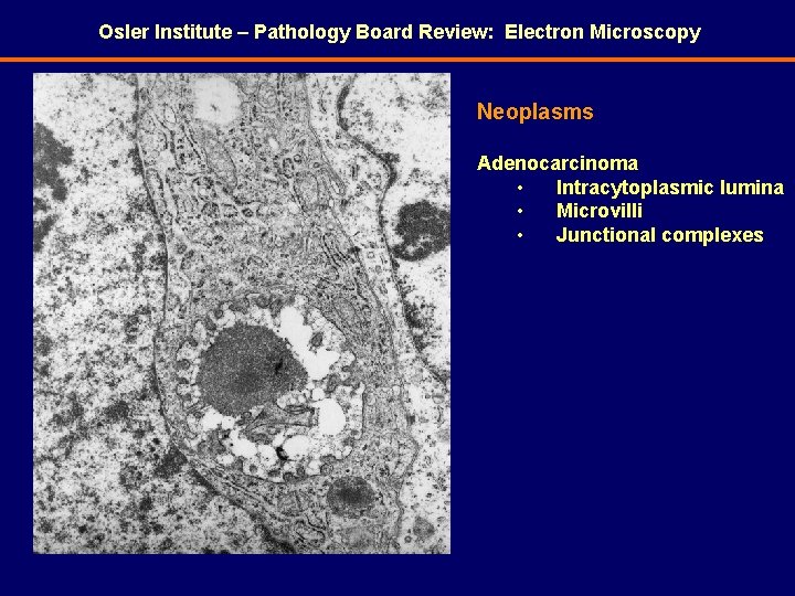 Osler Institute – Pathology Board Review: Electron Microscopy Neoplasms Adenocarcinoma • Intracytoplasmic lumina •