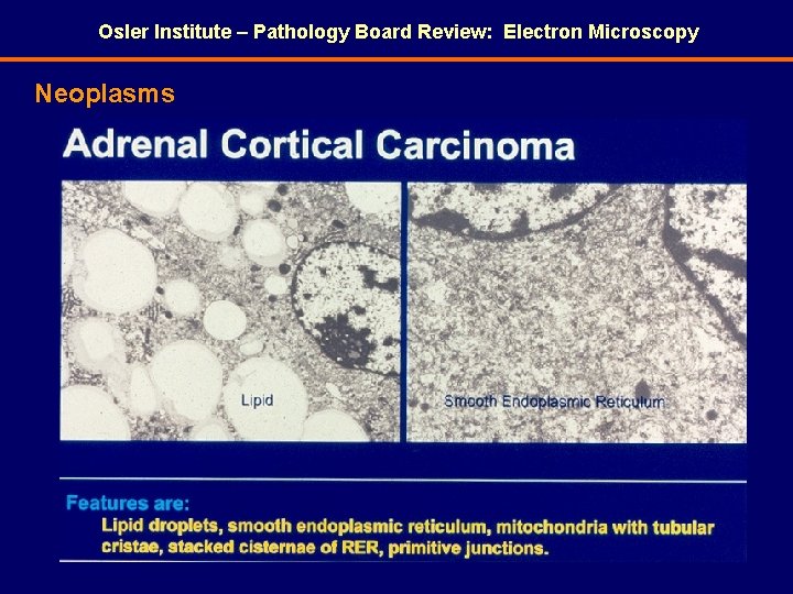 Osler Institute – Pathology Board Review: Electron Microscopy Neoplasms 