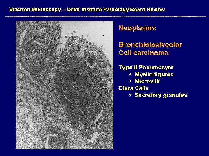 Electron Microscopy - Osler Institute Pathology Board Review Neoplasms Bronchioloalveolar Cell carcinoma Type II