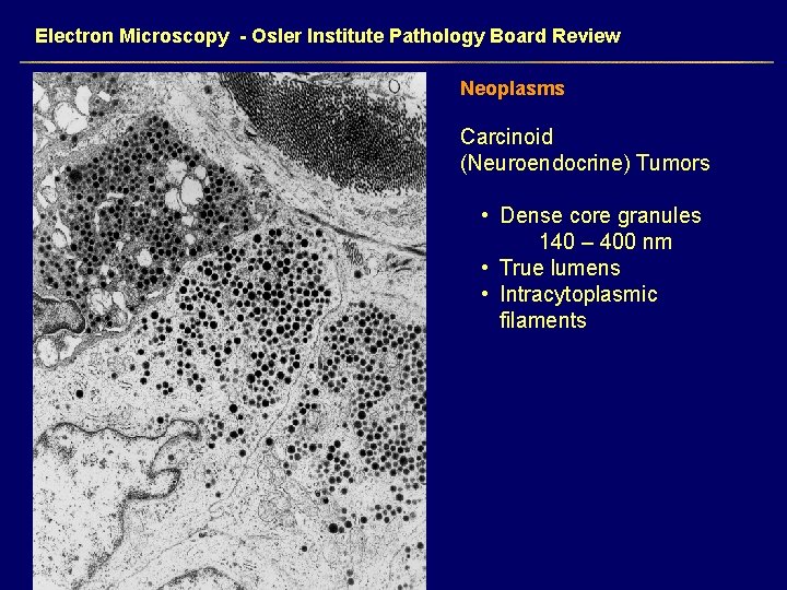 Electron Microscopy - Osler Institute Pathology Board Review Neoplasms Carcinoid (Neuroendocrine) Tumors • Dense