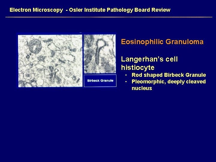 Electron Microscopy - Osler Institute Pathology Board Review Eosinophilic Granuloma Langerhan’s cell histiocyte •