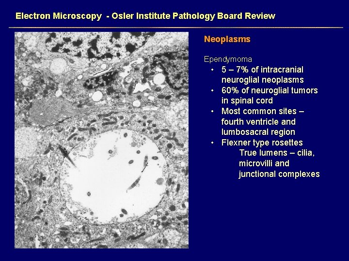 Electron Microscopy - Osler Institute Pathology Board Review Neoplasms Ependymoma • 5 – 7%