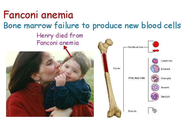 Fanconi anemia Bone marrow failure to produce new blood cells Henry died from Fanconi