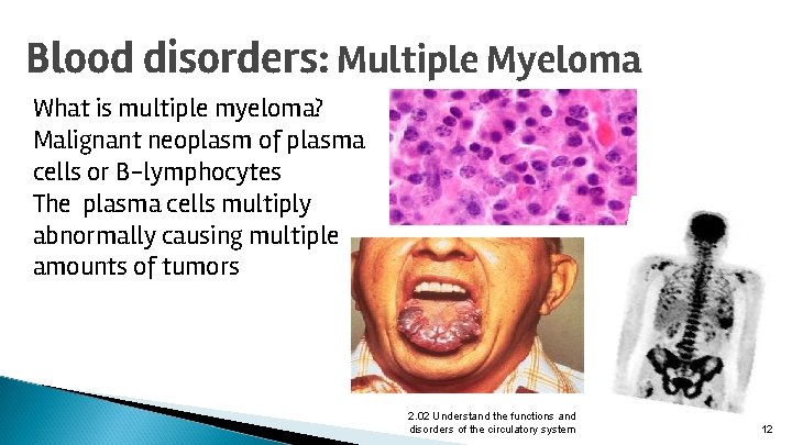 Blood disorders: Multiple Myeloma What is multiple myeloma? Malignant neoplasm of plasma cells or