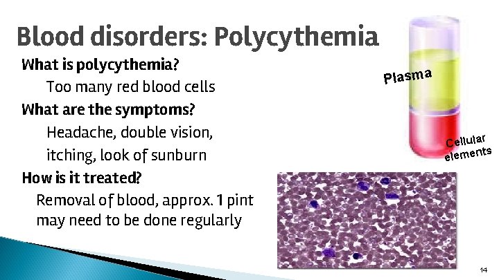 Blood disorders: Polycythemia What is polycythemia? Too many red blood cells What are the