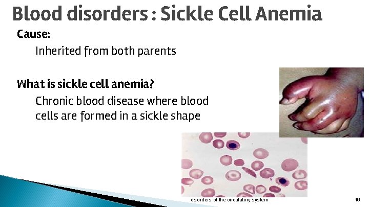 Blood disorders : Sickle Cell Anemia Cause: Inherited from both parents What is sickle