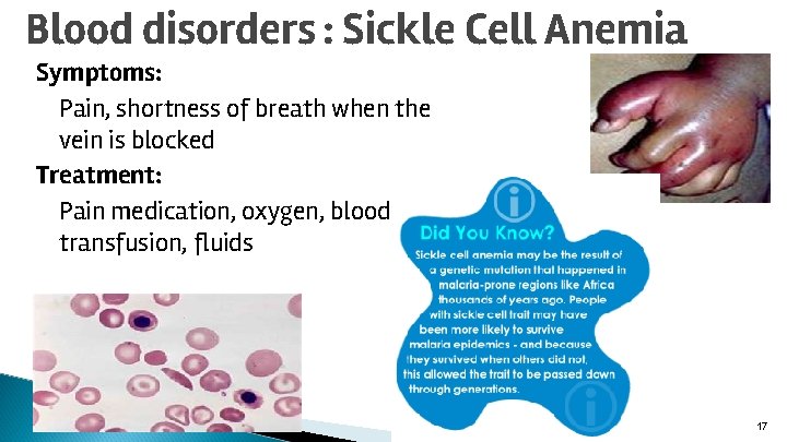 Blood disorders : Sickle Cell Anemia Symptoms: Pain, shortness of breath when the vein