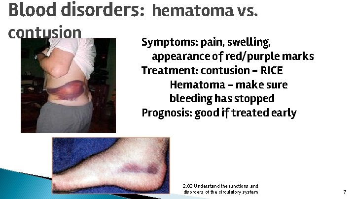 Blood disorders: hematoma vs. contusion Symptoms: pain, swelling, appearance of red/purple marks Treatment: contusion