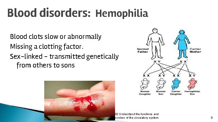 Blood disorders: Hemophilia Blood clots slow or abnormally Missing a clotting factor. Sex-linked -