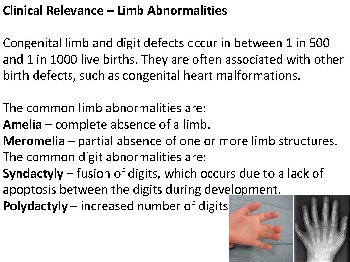 Clinical Relevance – Limb Abnormalities Congenital limb and digit defects occur in between 1