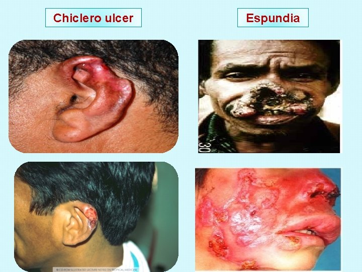 Chiclero ulcer Espundia 