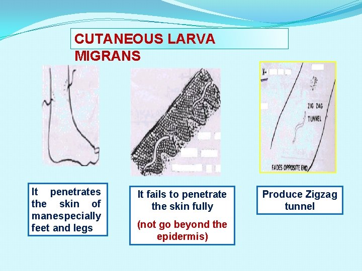 CUTANEOUS LARVA MIGRANS It penetrates the skin of man especially feet and legs It