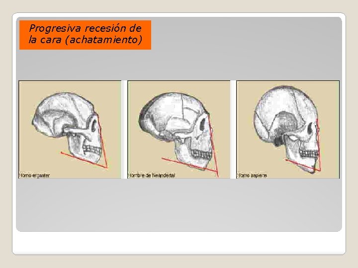 Progresiva recesión de la cara (achatamiento) 