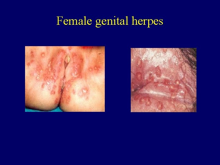 Female genital herpes 