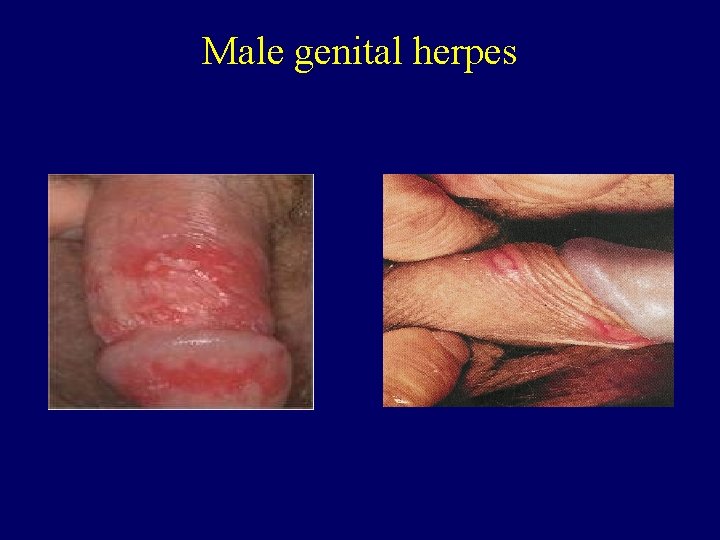 Male genital herpes 