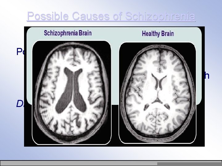 Possible Causes of Schizophrenia Possible causes of schizophrenia include genetics, abnormal brain structure (ventricles),