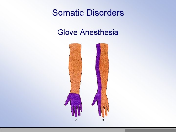 Somatic Disorders Glove Anesthesia Copyright © Allyn & Bacon 2007 