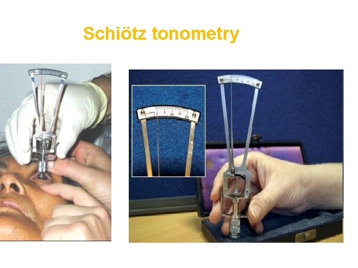 Schiötz tonometry 