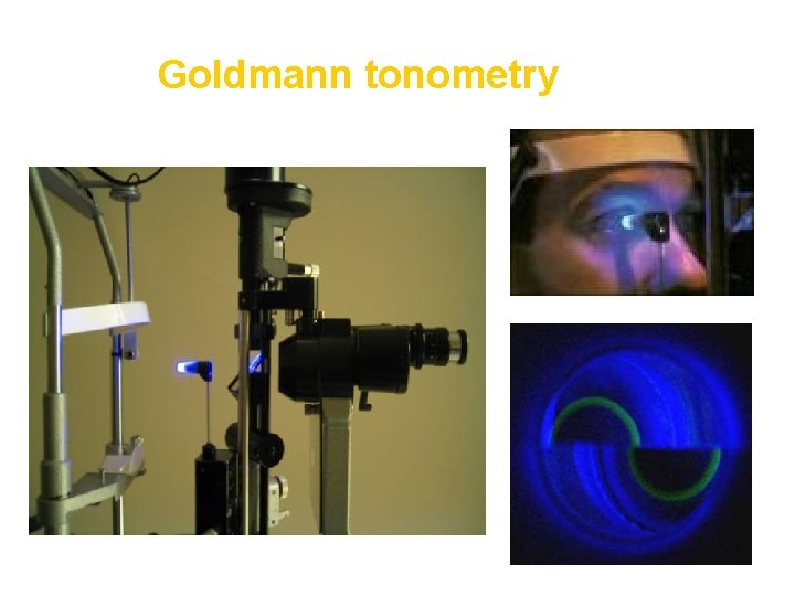 Goldmann tonometry 