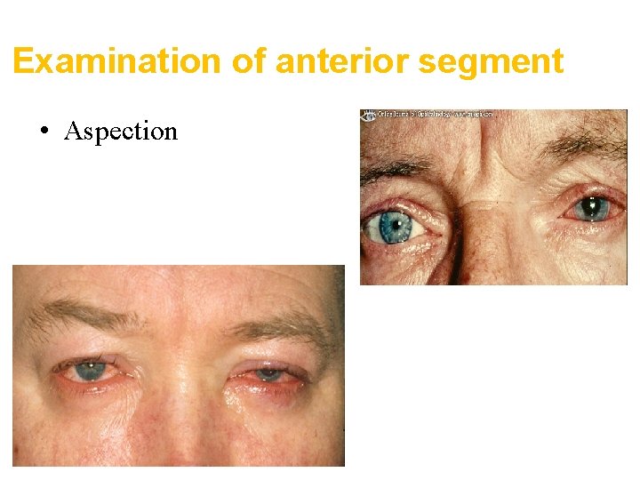 Examination of anterior segment • Aspection 