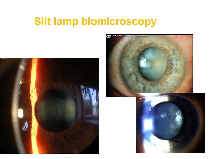 Slit lamp biomicroscopy , 