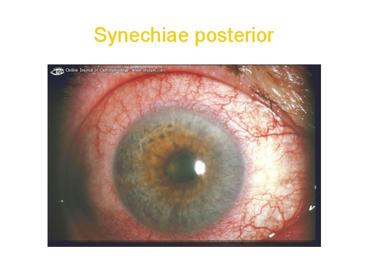 Synechiae posterior 