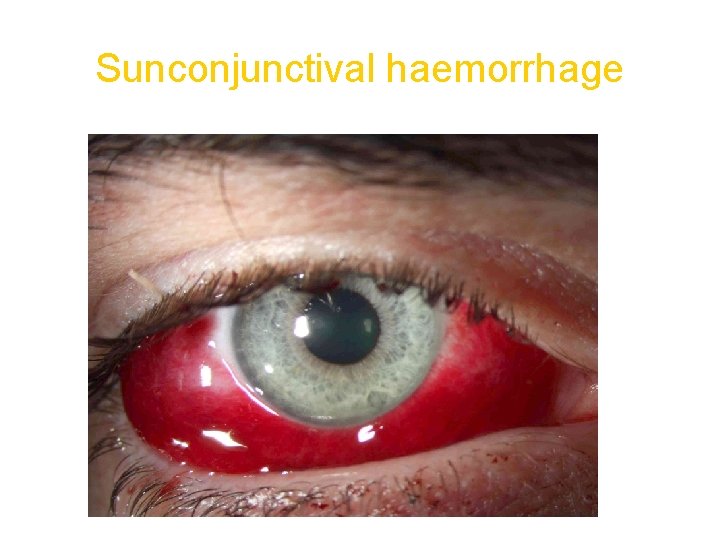 Sunconjunctival haemorrhage 