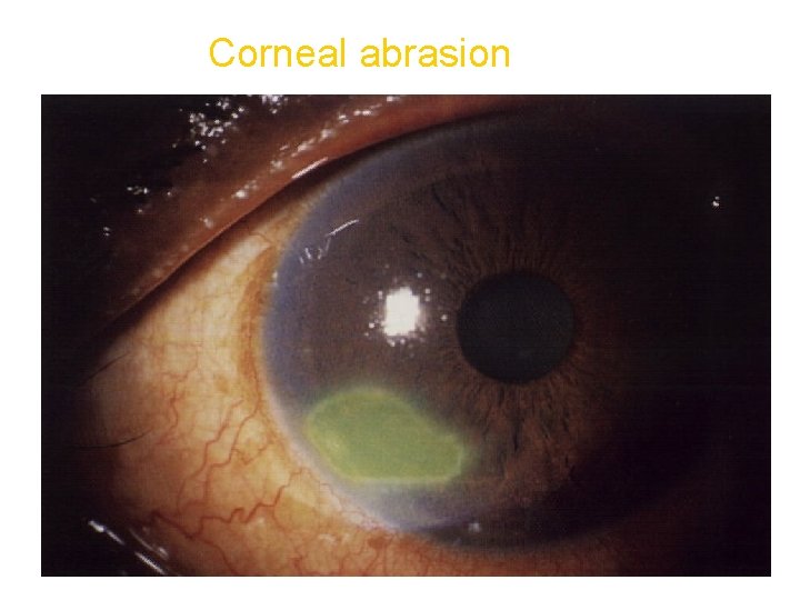 Corneal abrasion 