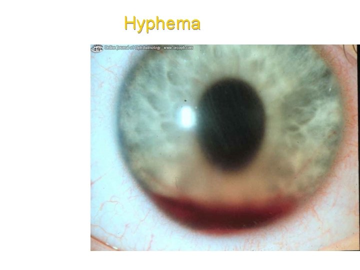 Hyphema 