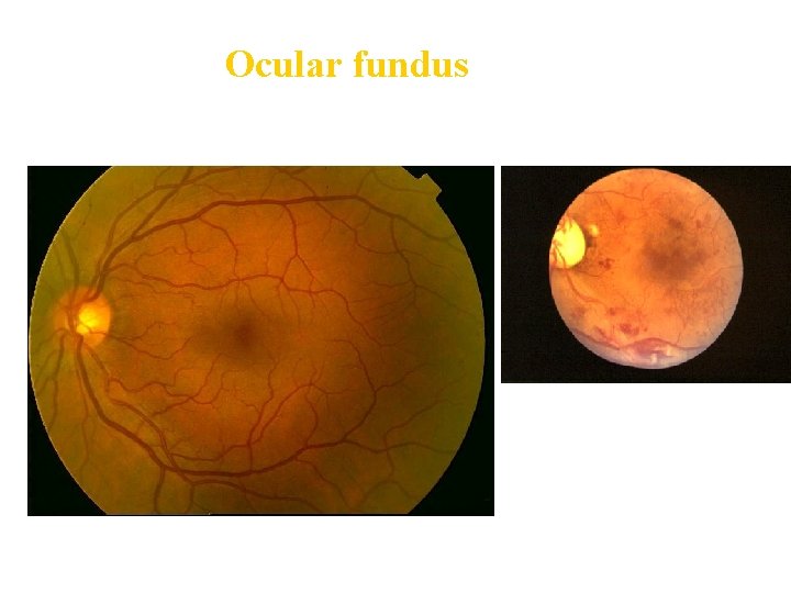 Ocular fundus 